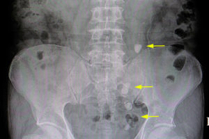 Kidney Stone Prevention