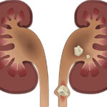 Nephrolithiasis kidney stones disease. Vector medical illustration isolated on white