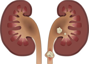Nephrolithiasis kidney stones disease. Vector medical illustration isolated on white