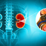 3D illustration of kidney stone disease.