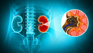 3D illustration of kidney stone disease.