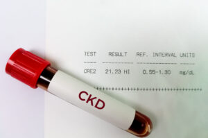 Blood sample isolated with Chronic Kidney disease or CKD, high Creatinine and BUN report.